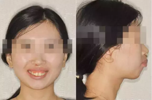 龅牙嘴突+露龈笑:牙齿矫正告诉你这些都还有救