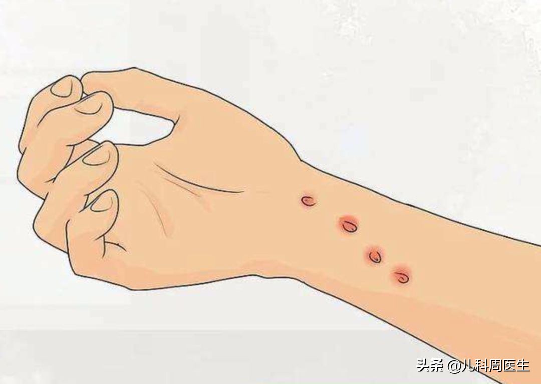 什么是儿童猫抓病(猫爪热)?有哪些表现?