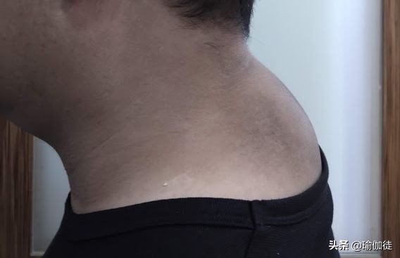 脖子后面凸一包是“富贵包”吗？如何消除？这个方法简单又有效