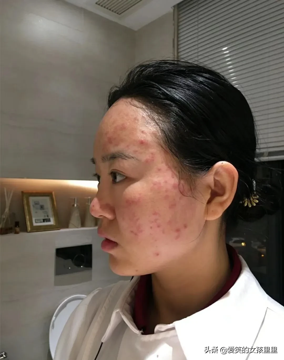 痘痘大约多长时间可以彻底消除(湖南的吴女士不到3个月的时间让痘痘彻底消失皮肤光滑细)