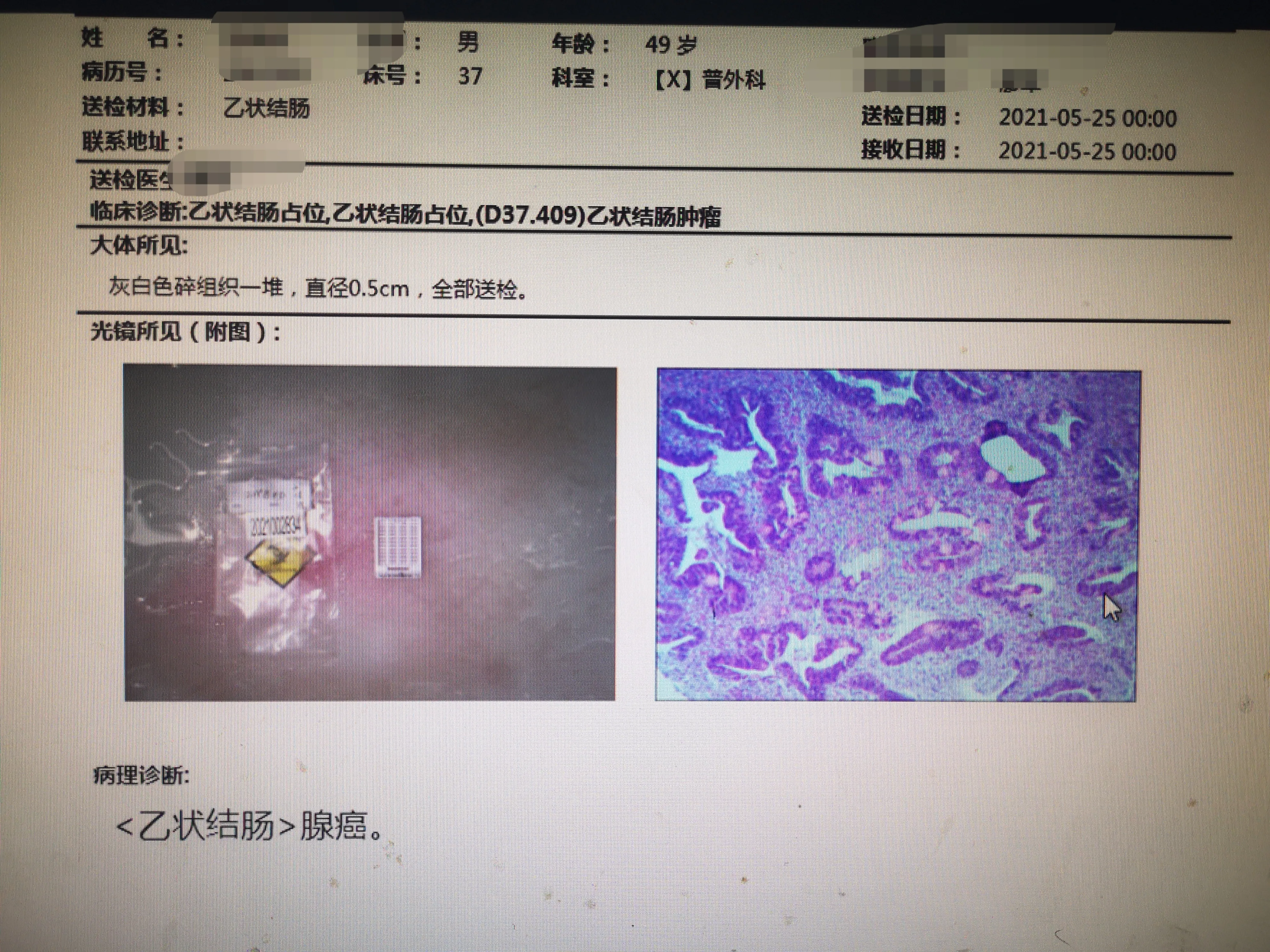 肠癌查癌胚抗原检查有用吗(身为医务工作者的同事体检发现癌胚抗原轻度升高未重视)