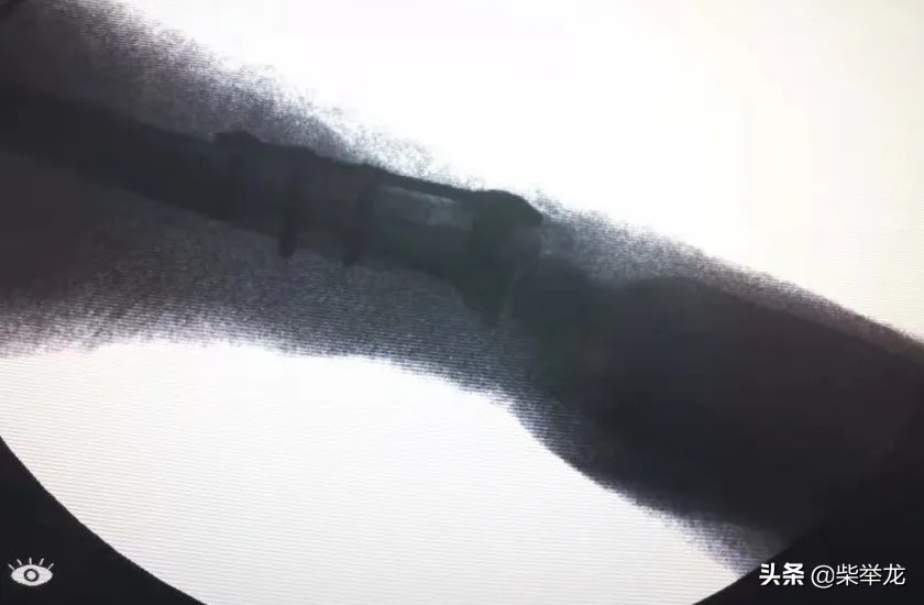 兰州连铝总医院外科近期完成多例复杂手术