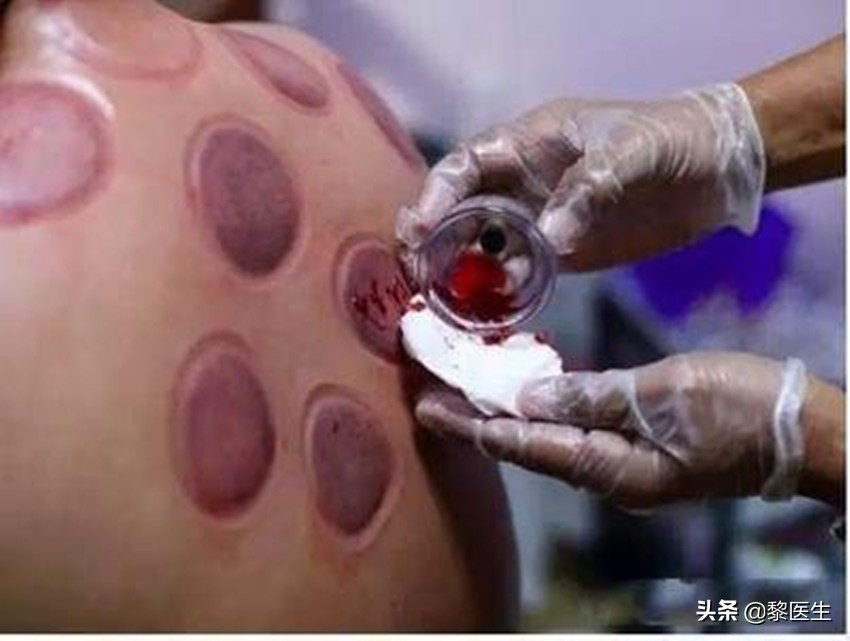 拔火罐对人体有何好处(21天图文打卡挑战拔火罐对身体有什么作用？)