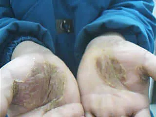银屑病反复不好就用一招调理好(感谢邀请，马上入秋了，气温忽高忽低)