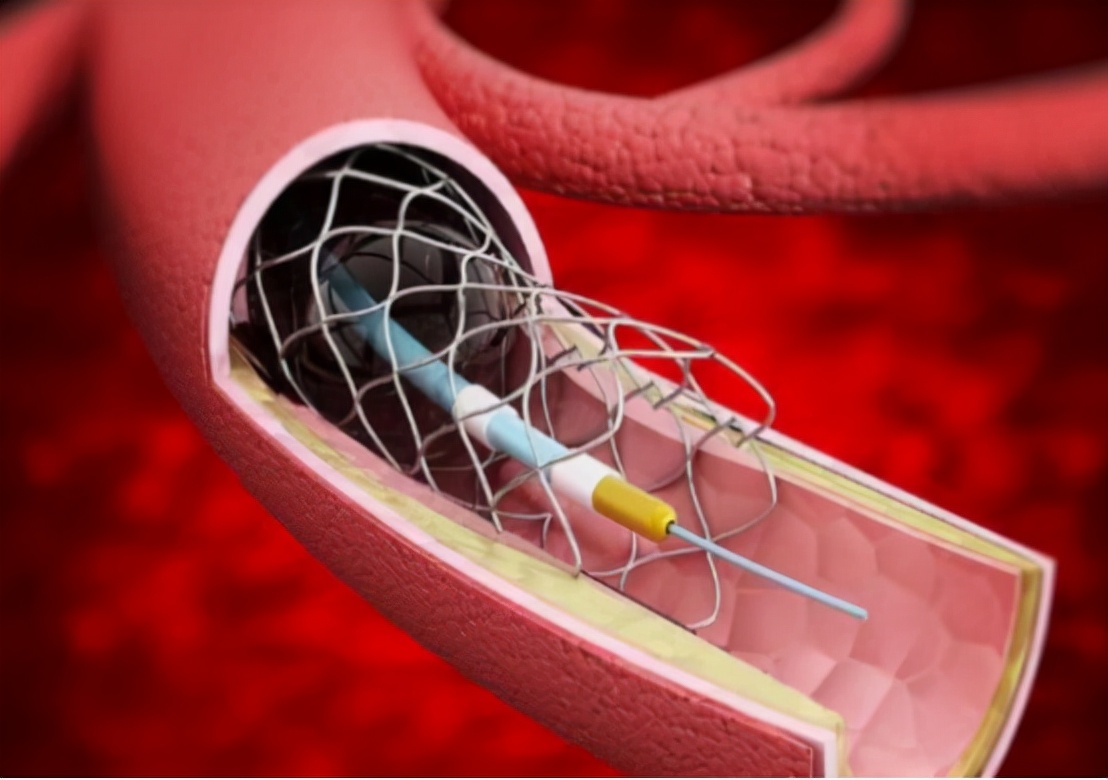 心脏支架后能活几年?和你实话实说:支撑生命的是这3点认知