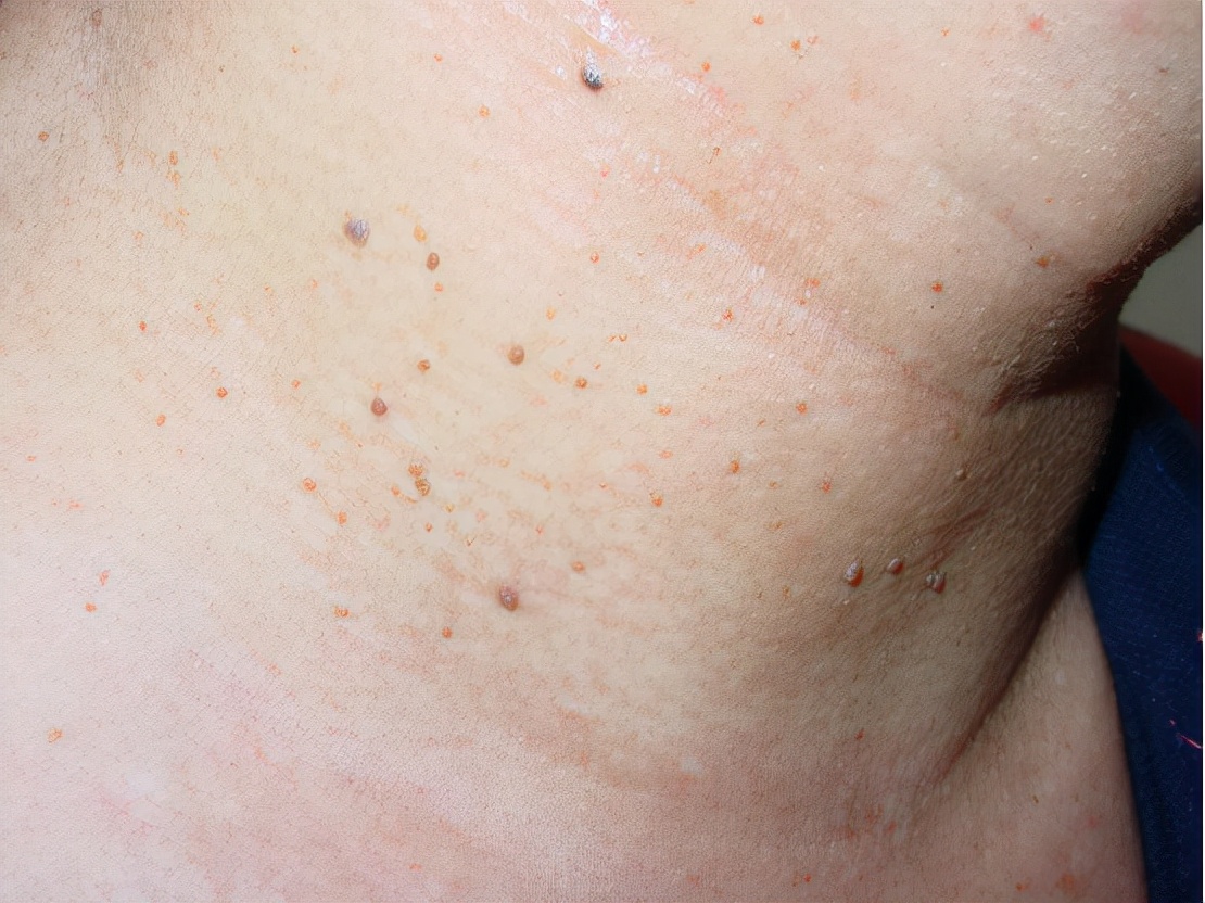 皮肤上的小肉球,小肉疙瘩是什么?不出意外,这4种可能性较大