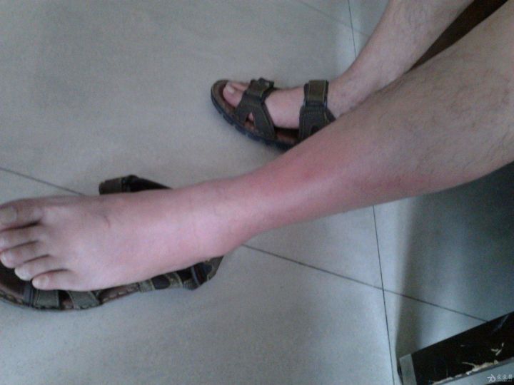 脚背癣图片(脚气引起下肢丹毒) - 赤虎壹号