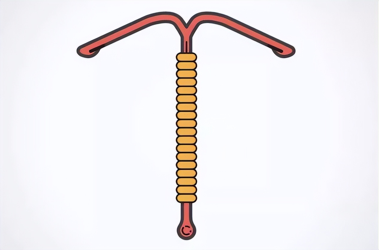 医生提醒:最佳取环年龄别超这一数