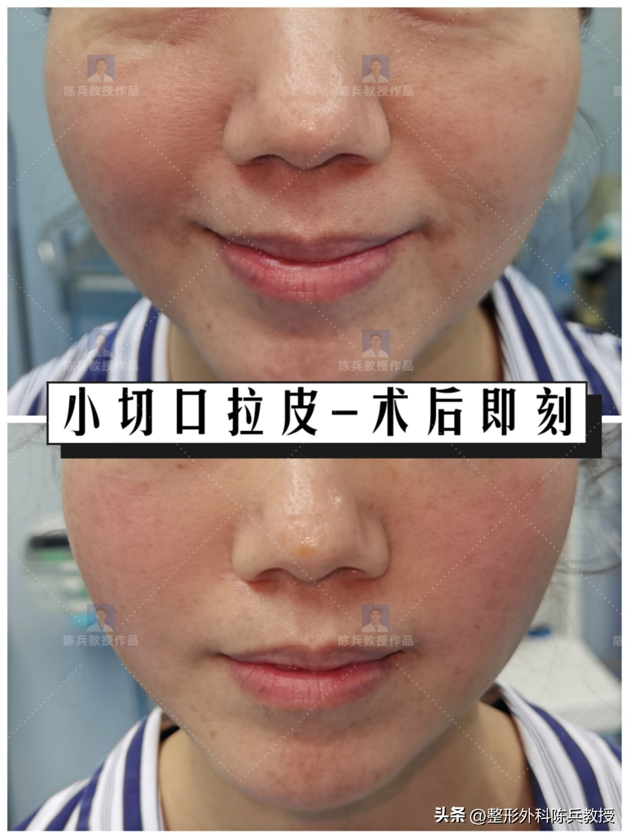 皮肤屏障受损期间怎么抗衰(抗衰就是拉皮，最怕的就是疤痕、疼痛、肿胀……)
