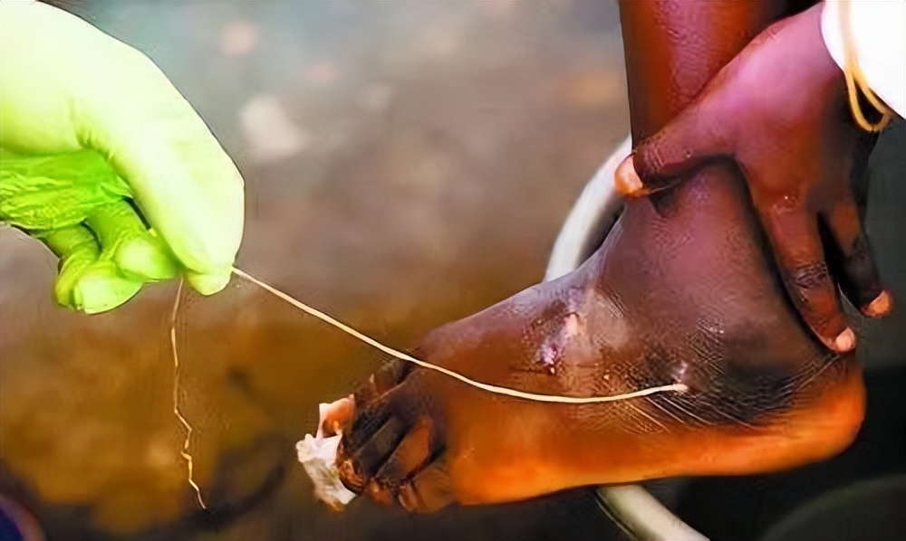 这4种食物容易有寄生虫可能开水烫不死，春季吃啥之前要小心寄生虫?