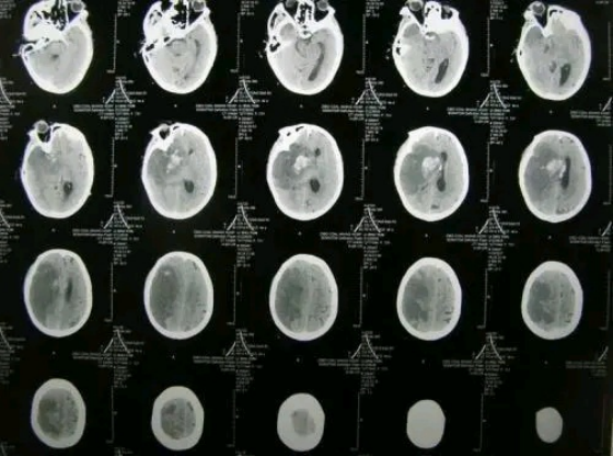 50岁后查脑CT，出现这4种问题，不需要特殊治疗，别被坑了