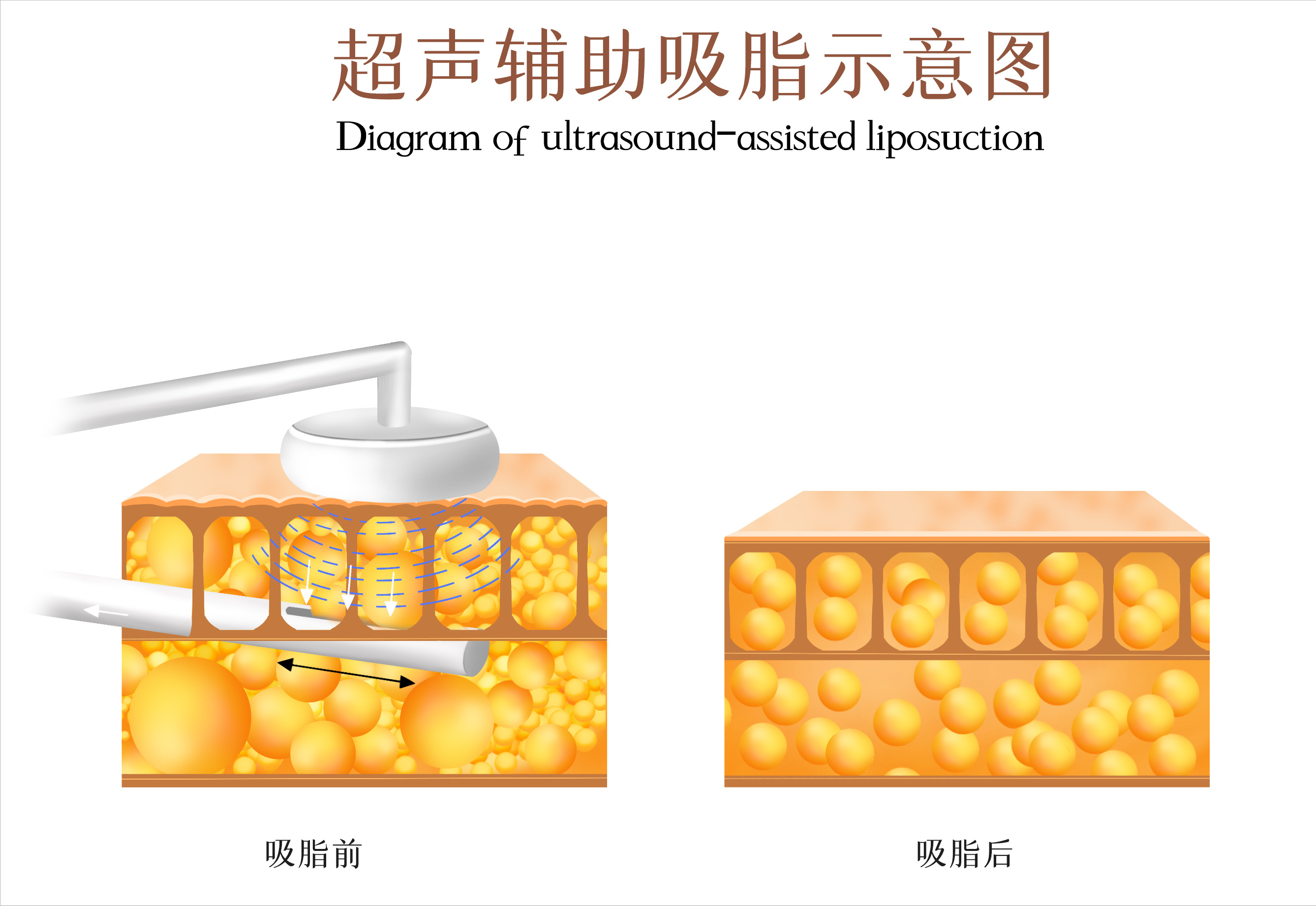 吸脂这个技术现在成熟么？ - 知乎