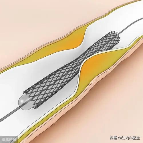 放置心脏支架选择进口的好还是国产的好？医生一文告诉你