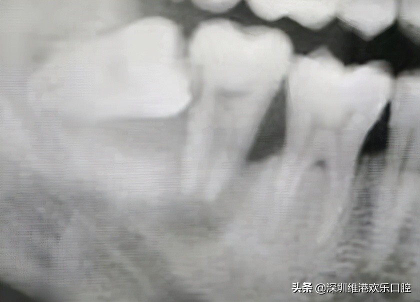 深圳种植牙专家高利民医师，宣导回归医疗本质、以人为本