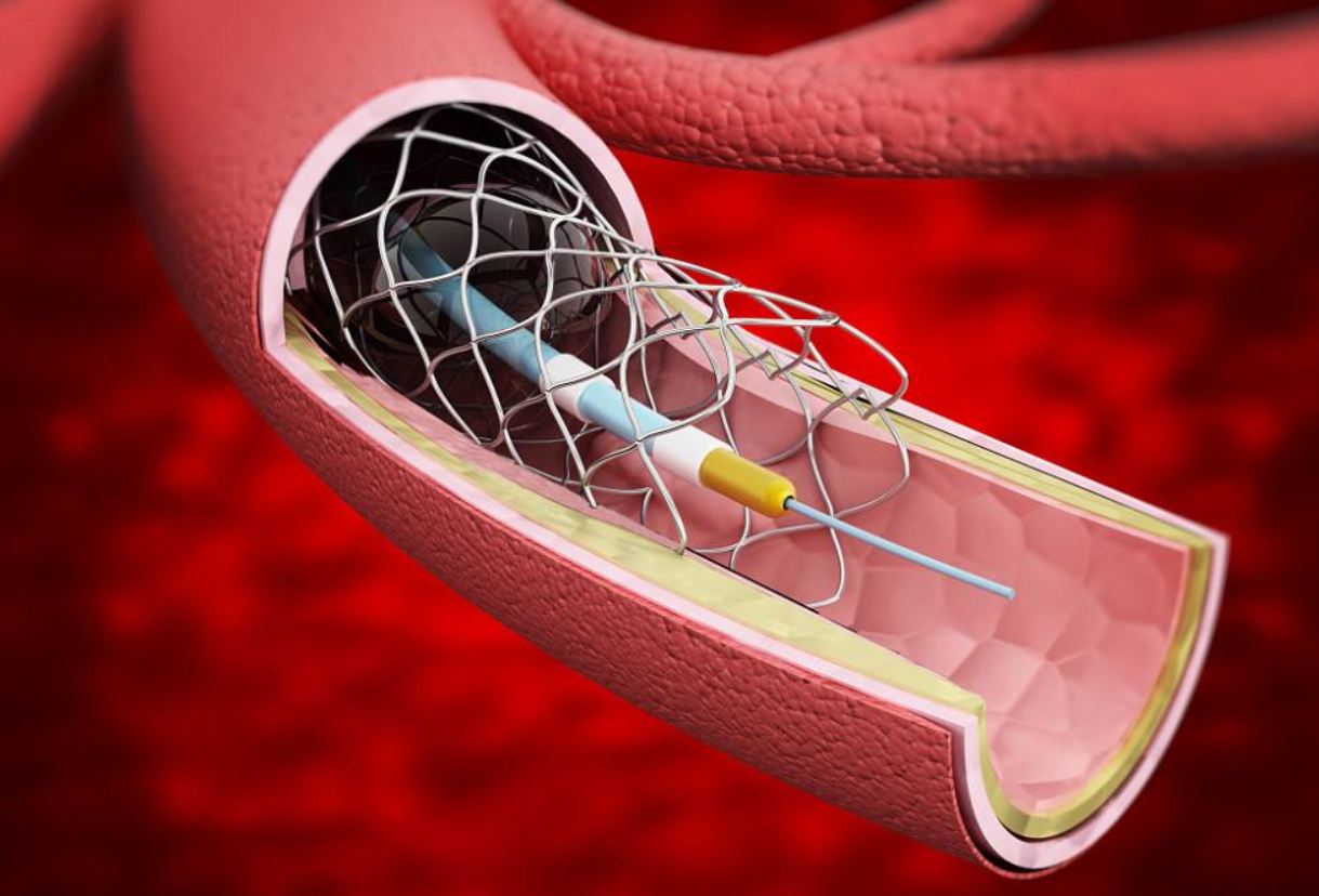 心脏支架手术真相:是治病救人还是"缺德害人"?做了能活几年?