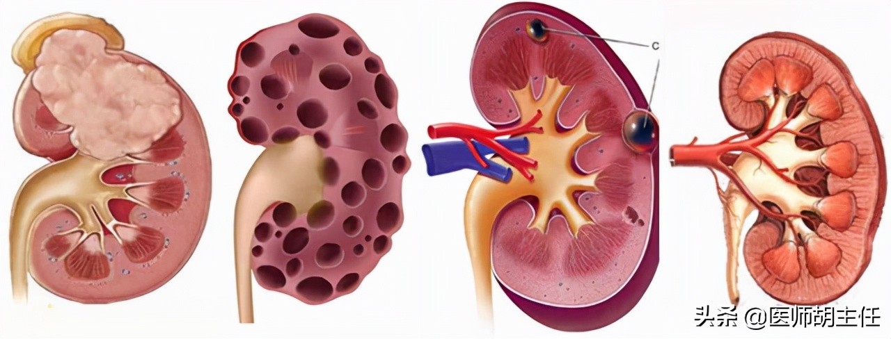 体检发现肾囊肿怎么办？医生告诉你最佳的应对方法