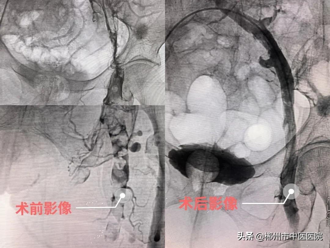 面对血栓!我们该怎么办?