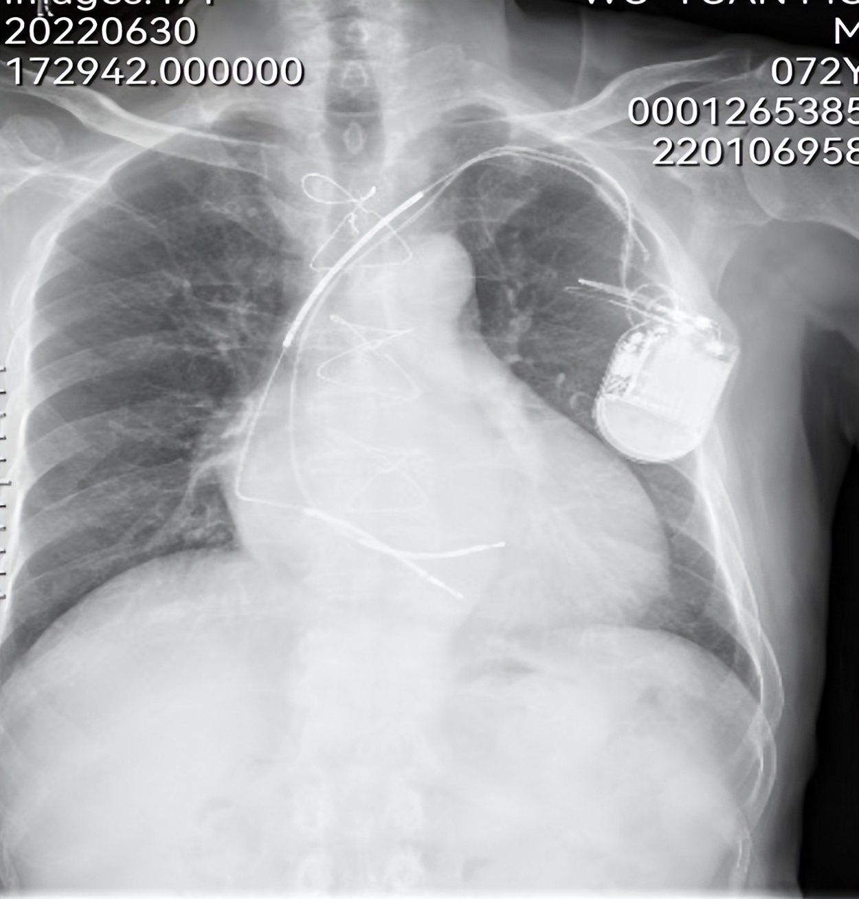 仁医病例丨成功拔除植入9年的除颤电极