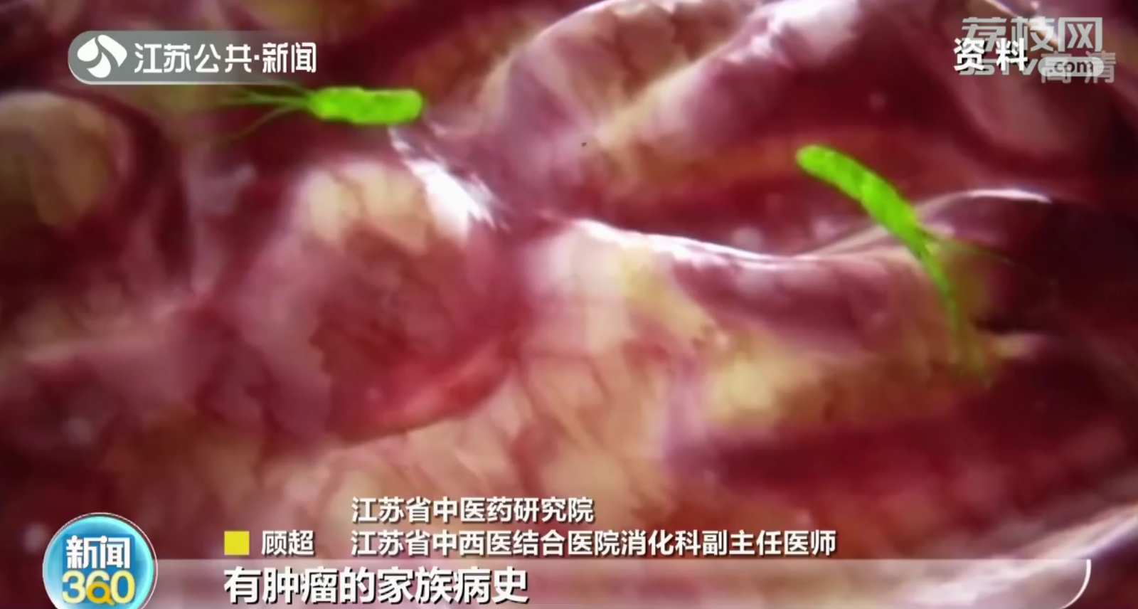 陪丈夫复查妻子查出早期胃癌 40岁以上要重视胃肠镜检查