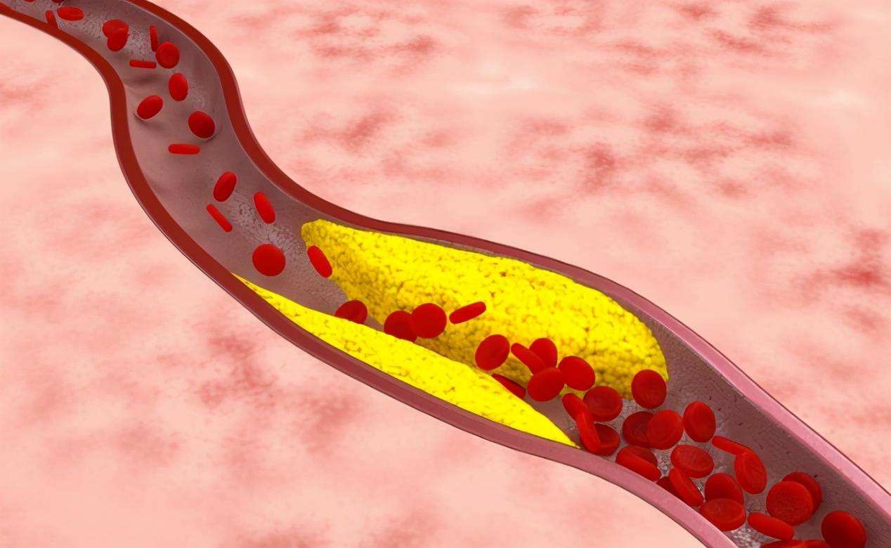 越上岁数越容易血管堵塞，尤其头部出现这3种变化，是给你的暗示