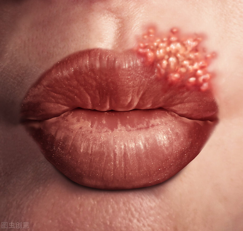 嘴上长水泡,它是口腔溃疡还是唇疱疹,你如何摆脱它?挑破水泡?