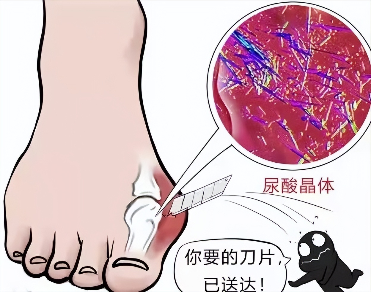 尿酸高了就一定会得痛风吗？来看看“尿酸”那些事