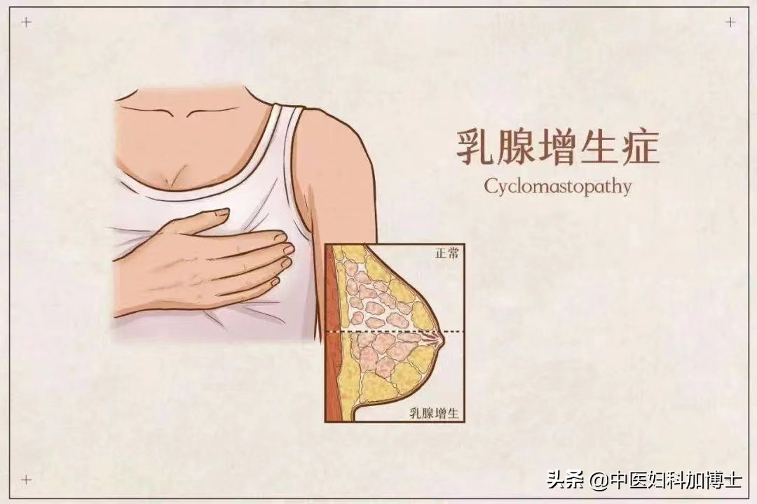 乳房经前又胀又痛，它里面到底长了啥？