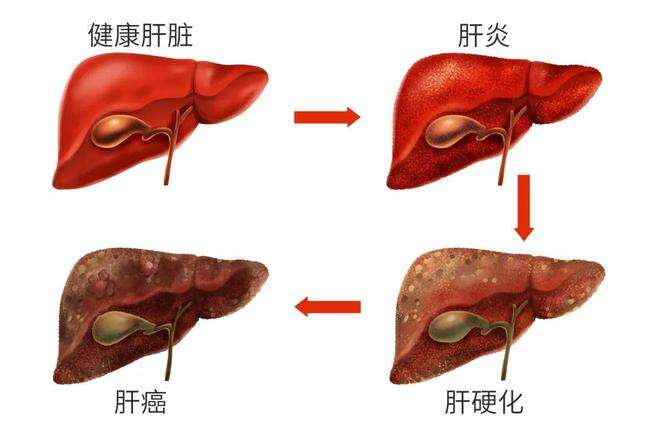 肝区疼痛、不适，可能是这5种情况！该做什么检查？医生告诉你