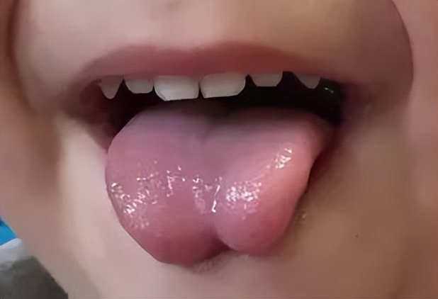 小孩舌苔正常图片图片