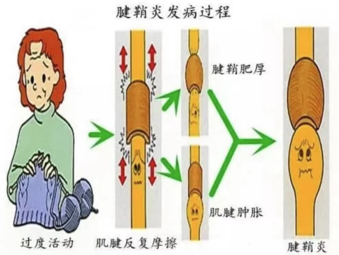 科普腱鞘炎不可小觑的关节疾病