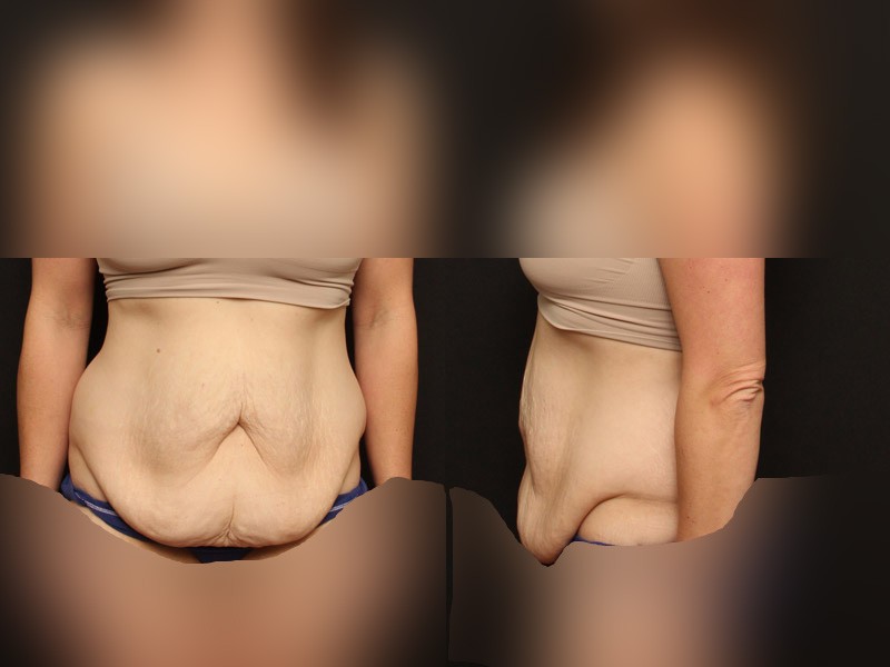 剖腹产后的双层肚、屁股肚，你有这些问题吗？做腹壁成形怎么样？