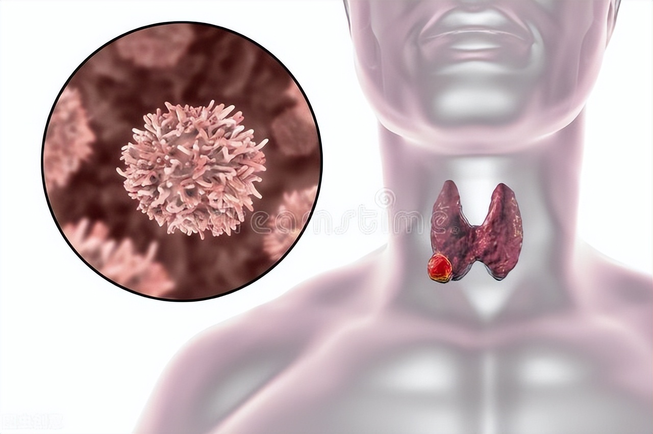 体内有癌，颈部先知。颈部出现3种症状，当心癌症可能来访