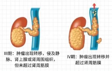 保肾 vs 肾全切，得了肾癌该如何选择？