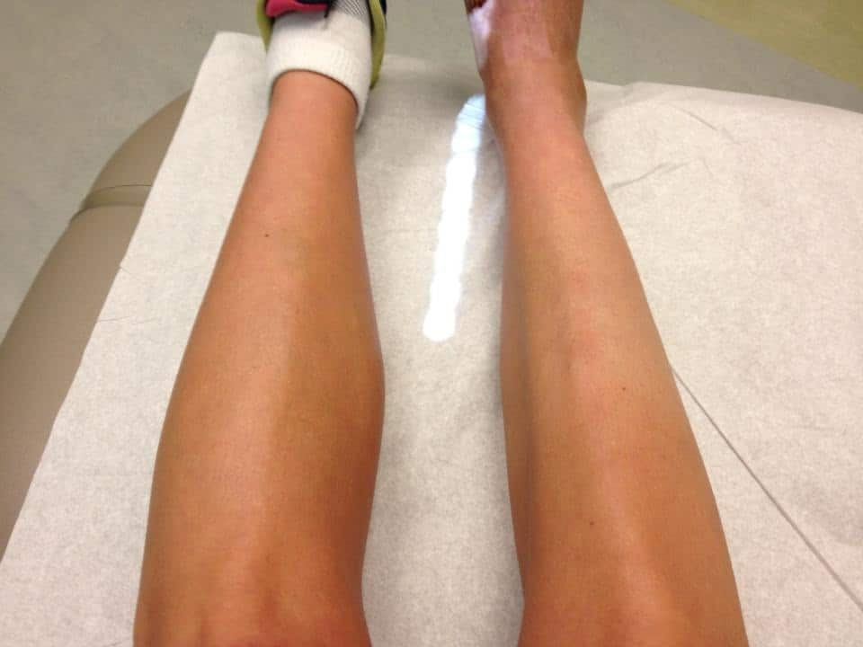 一步康复,结果在家卧床休养了一个多月后才发现,腿部肌肉萎缩得很厉害