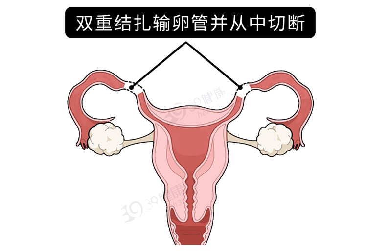 男性结扎和女性结扎，哪个伤害更大？男性结扎会降低性能力吗？