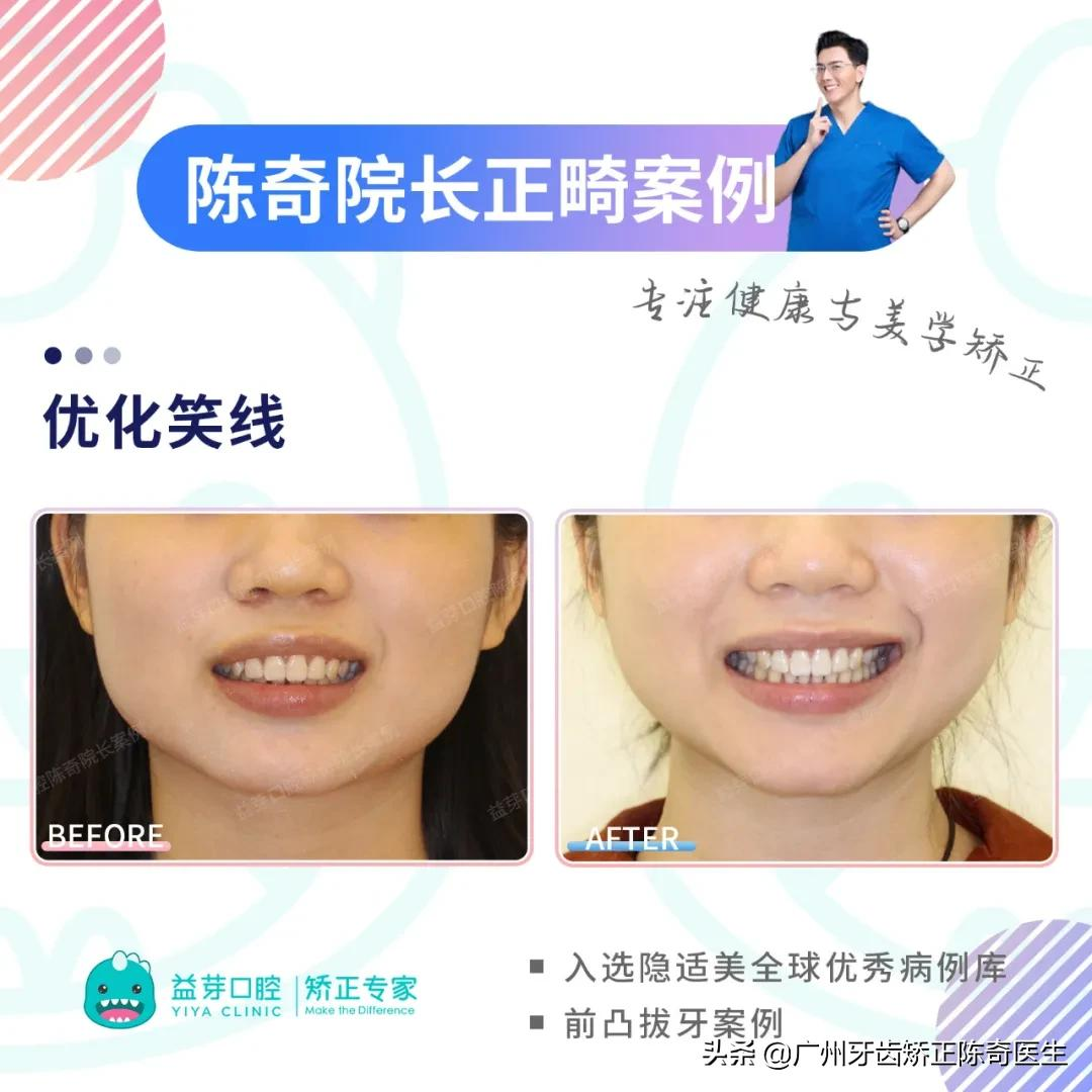 全球优秀案例 | 隐适美拔牙矫正1年半时间解除牙列间隙、改善嘴凸