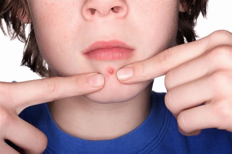 13岁女孩挤痘痘诱发败血症！看似平常的5个小动作，可能会致命