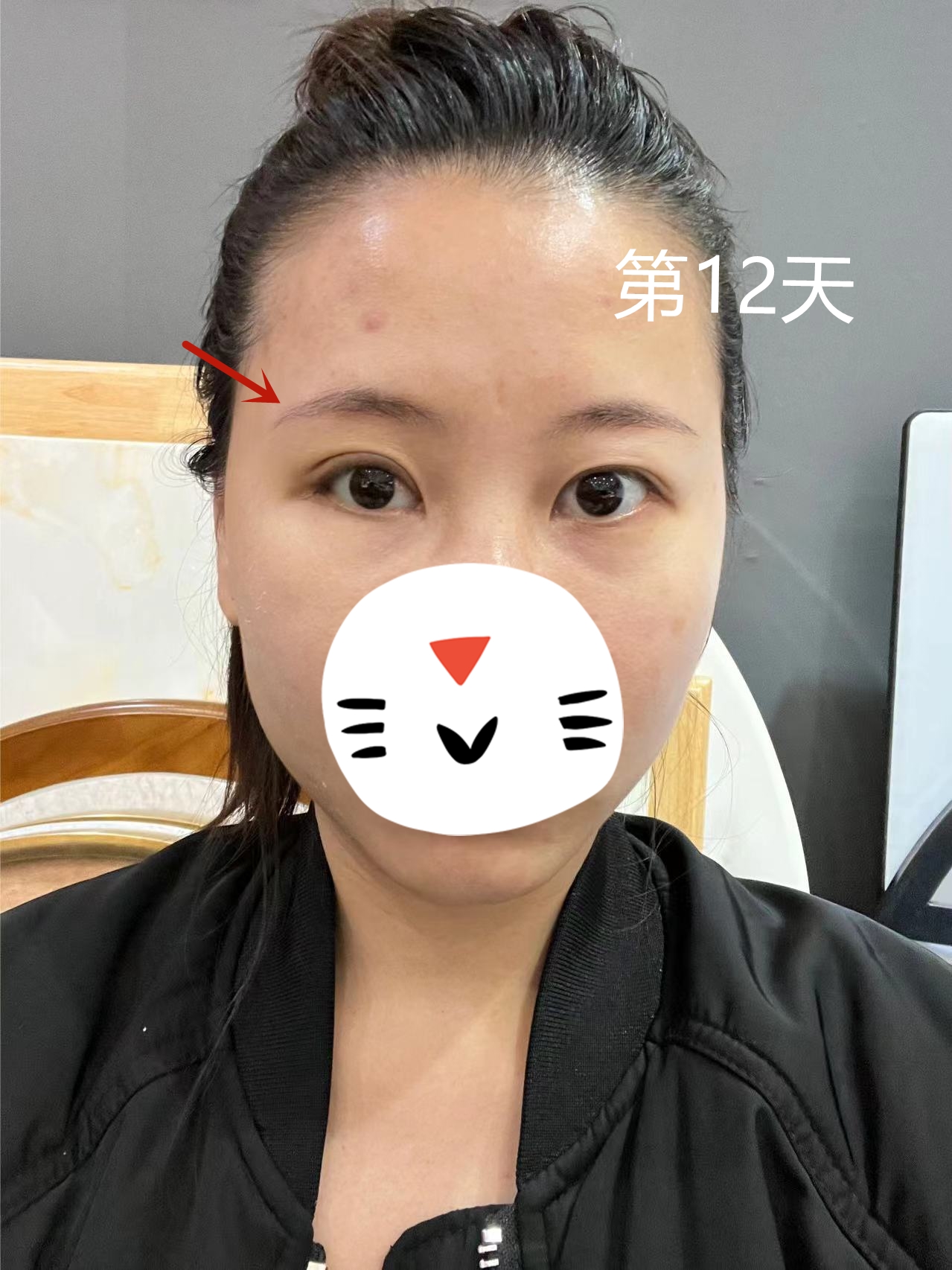 单眼上睑下垂修复第12天,小姑娘开心地说"特别满意感谢医生"