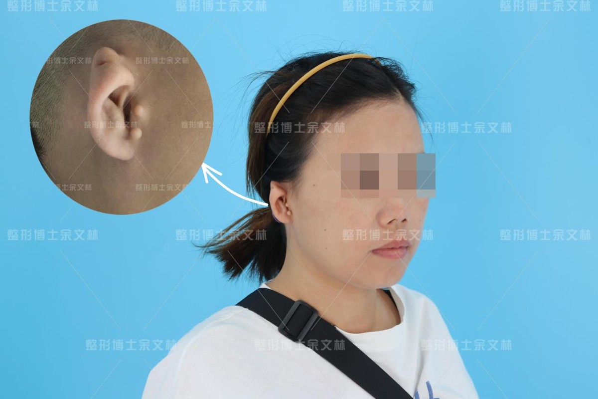「案例分析」右耳比左耳小，31岁小耳畸形患者忙做手术矫正