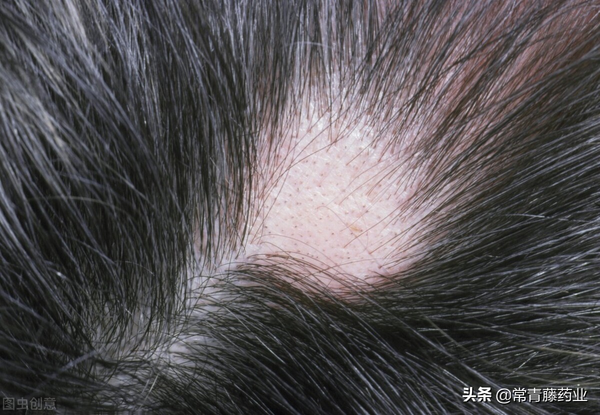 脂溢性脱发的诊断方法与四种常见脱发类型的鉴别要点