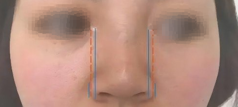 “看似”扁塌的鼻型应该如何改善？