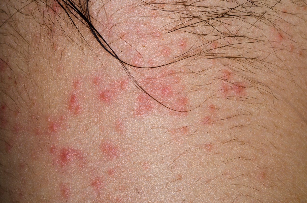 过敏体质的人免疫力更高，不易患癌？这4种人才是癌症高发人群