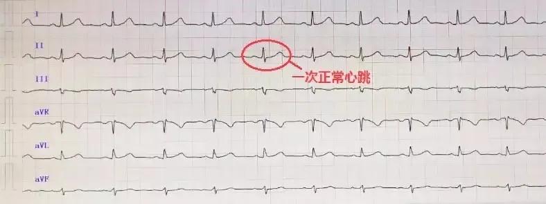 心律不齐什么鬼？教你轻松读懂心电图