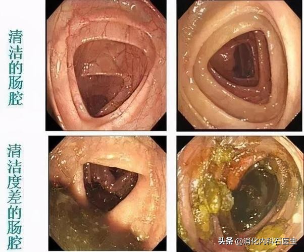 肠镜检查发现结肠息肉3个，做手术时却发现5个，为什么？