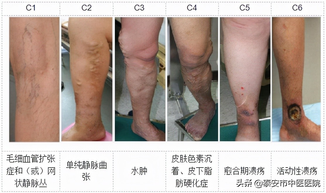 静脉曲张必须要住院治疗吗泰安市中医医院轻松帮您赶走小蚯蚓