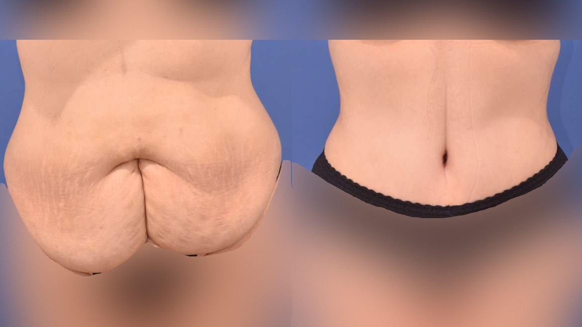 剖腹产后的双层肚、屁股肚，你有这些问题吗？做腹壁成形怎么样？