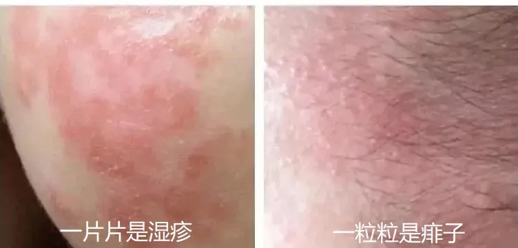 又一网红宝宝霜出事了!6大常见疹子,治疗千万别乱来