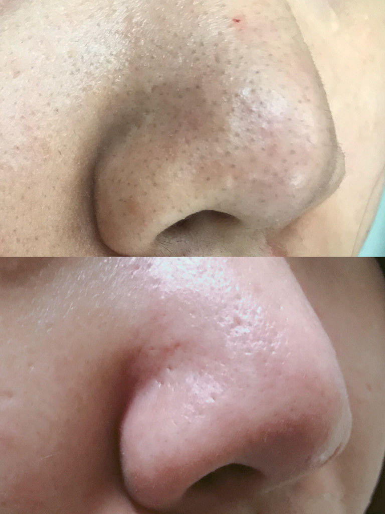 鼻子毛孔里有白色的粒粒怎么办？忍不住照镜子扣，有什么办法吗？