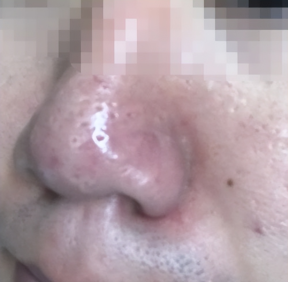 为什么上完粉底液以后，鼻子上有很多白点点？
