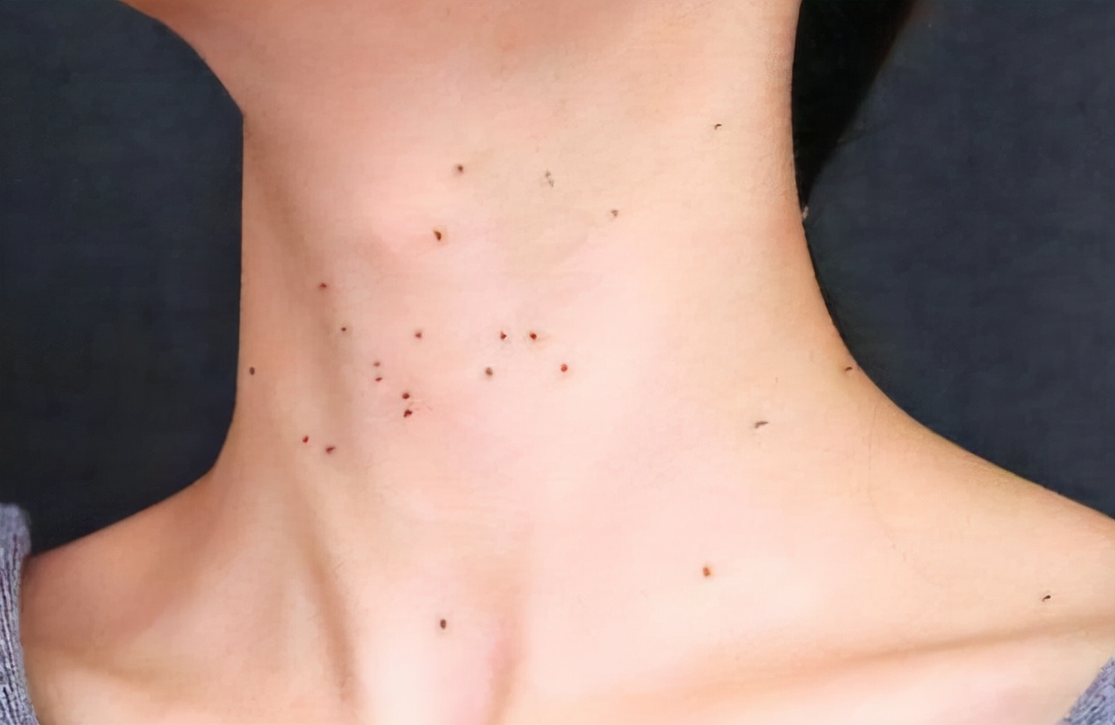 人乳头瘤病毒早期图片(女人身体3处) - 赤虎壹号